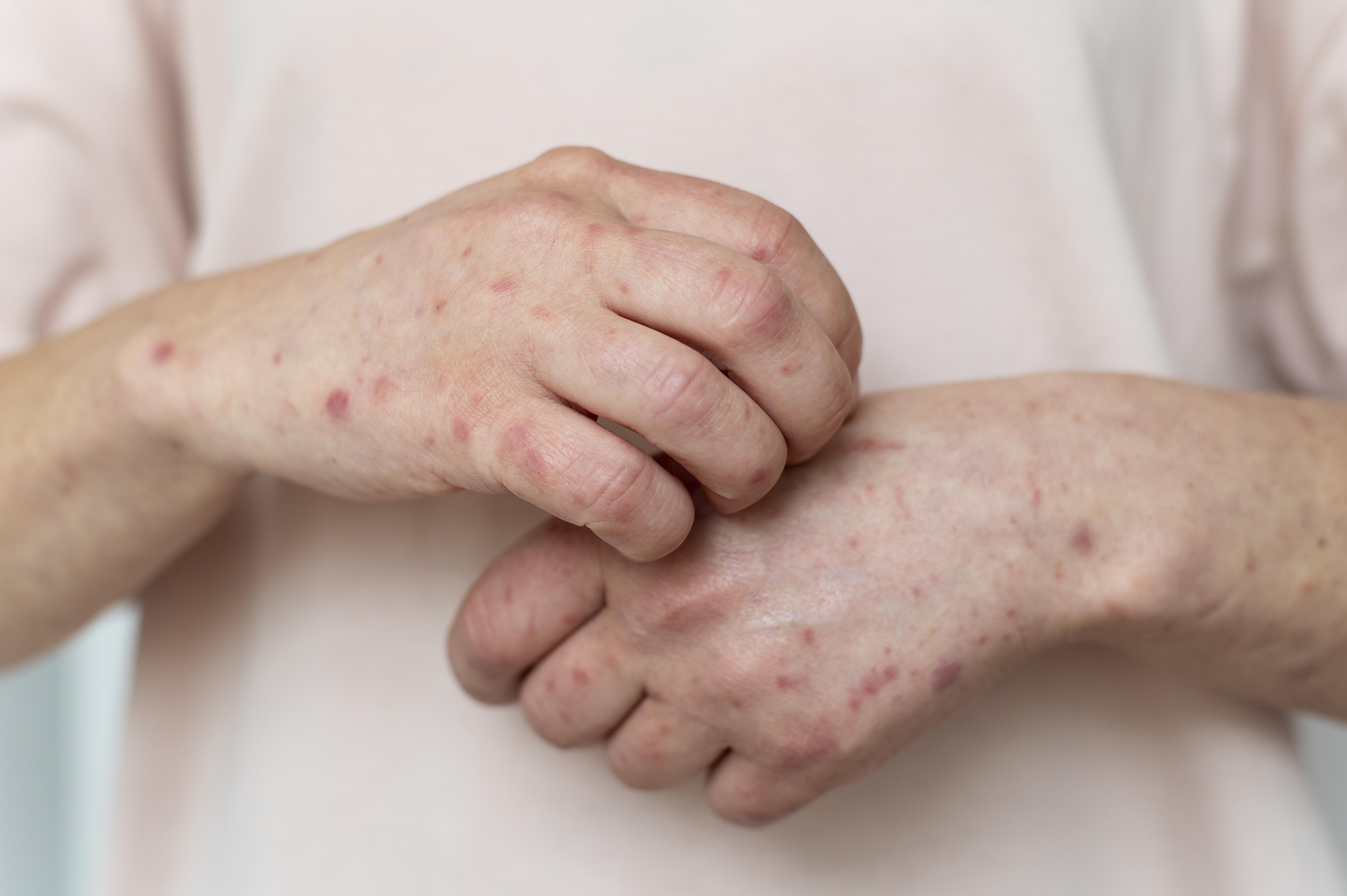 Rigidez na nuca, febre e vômito: quando os sintomas podem indicar meningite