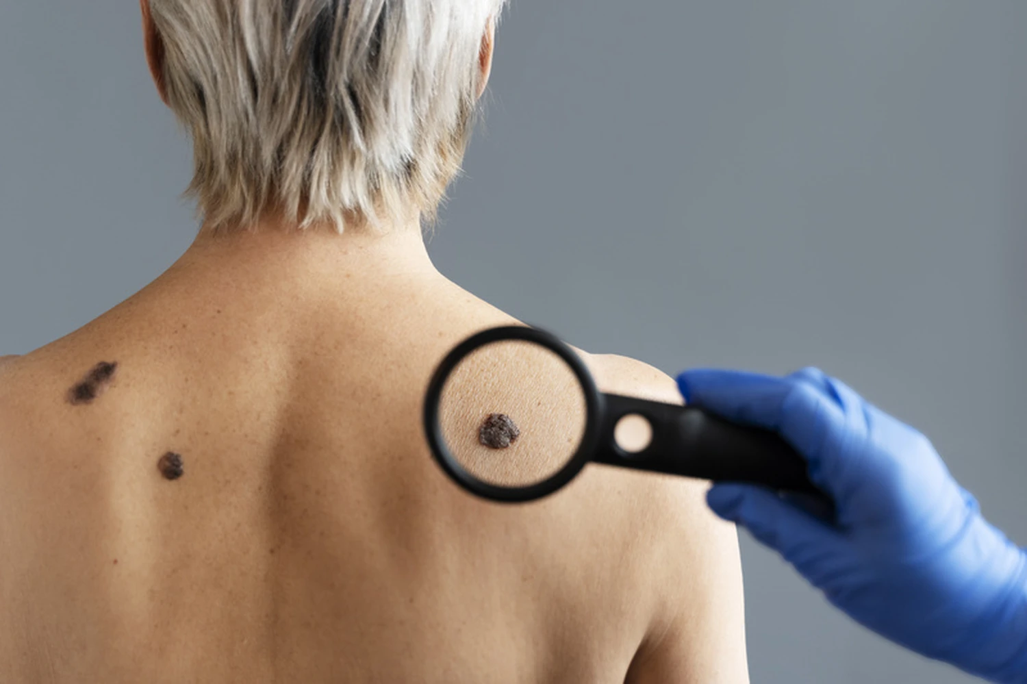 Brasil deve registrar mais de 9 mil novos casos de melanoma por ano